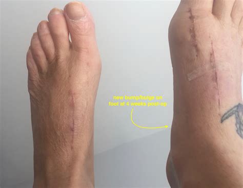 Before During And After Bunion Surgery Four Weeks Post Op Second