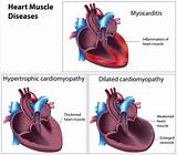 Images of Cardiovascular Disease Symptoms And Treatment