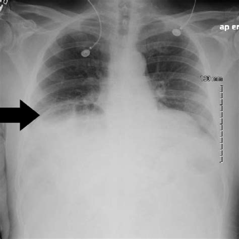 Figure Upright Chest Radiograph Demonstrating Chilaiditi Sign