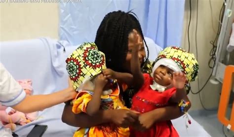 Conjoined Twin Sisters Looked At Each Other For First Time After