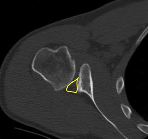 Posterior Instability | Boston Shoulder Institute