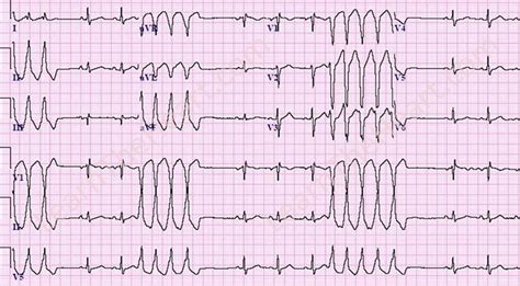 Non Sustained Ventricular Tachycardia Ecg Example 1