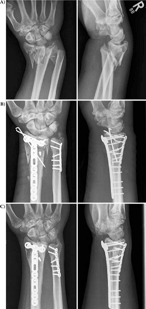 Distal Forearm Fracture In The Adult Is Orif Of The Radius And Closed