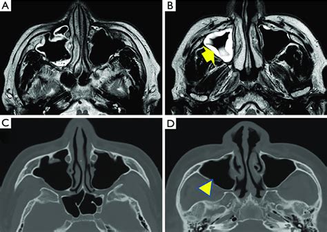 MRI And CT Images Suggest Acute Sinusitis A B Axial Views Of The