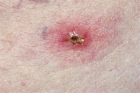 Infected Tick Bite Stock Image C0167236 Science Photo Library