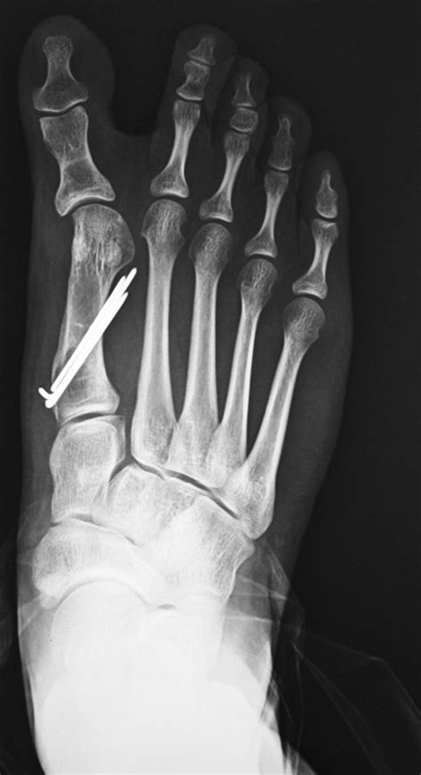 Hallux Varus Foot And Ankle Orthobullets