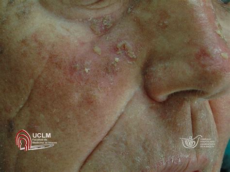 Queratosis Actínicas Faciales