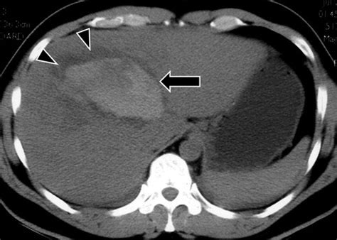 Ct In Blunt Liver Trauma Radiographics