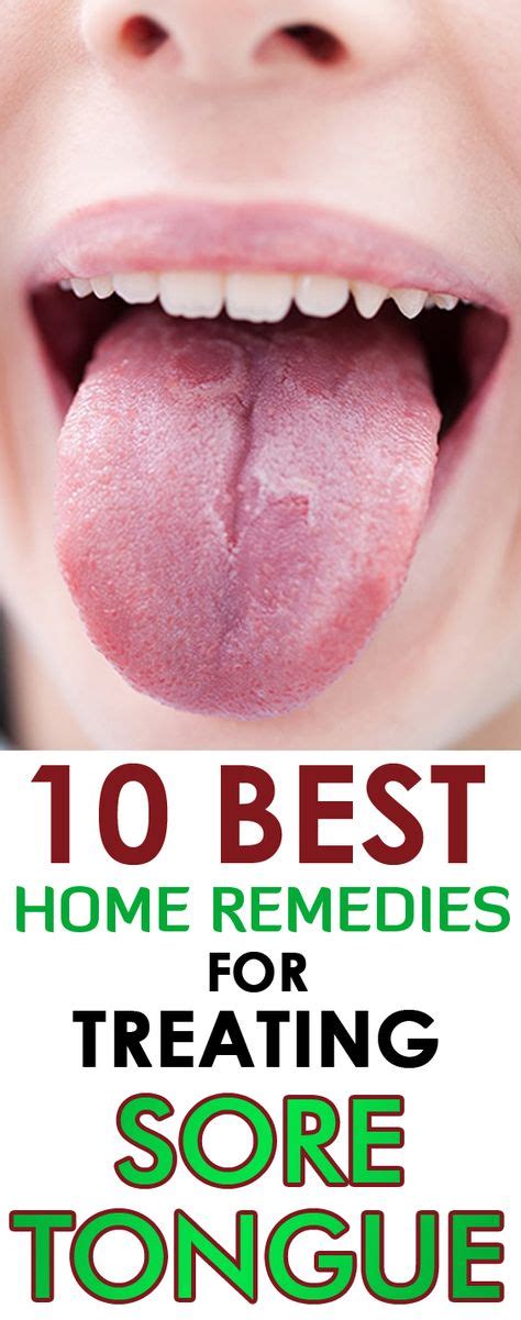 The 25 Best Sore Tongue Ideas On Pinterest Sore Tongue Remedies