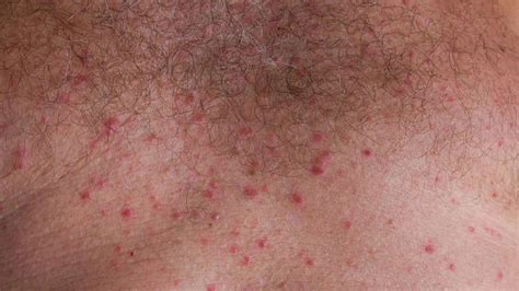 Rash In Groin Area Female Rashes In The Elderly Identification And Treatment