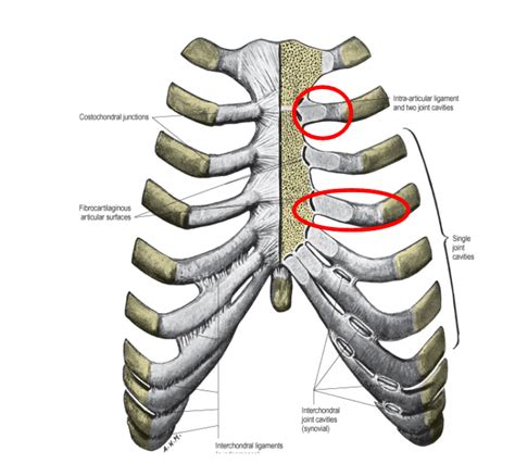 Costochondritis As A Cause Of Undiagnosed Chest Pain Costochondritis