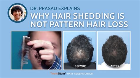Differentiating Hair Loss From Normal Hair Shedding Youtube
