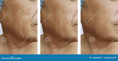 Elderly Men S Wrinkles Removal Medicine Injection Health On The Face