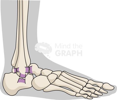 Ankle Sprain Severe Lateral Body