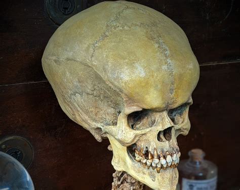 Large Cranium Hydrocephalic Human Skull Skeleton Sculpture Horror