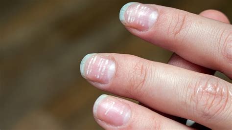 Whats Causing White Spots On Your Nails Goodrx
