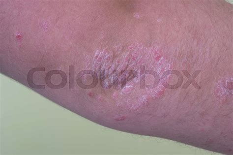 Psoriasis On Elbow Closeup Stock Image Colourbox