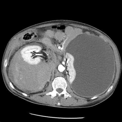 Floating Kidneys Associated With Eisenmenger Syndrome Kidney