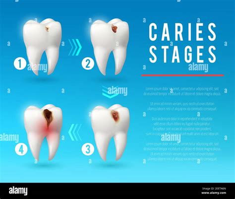 Stages Of Dental Caries