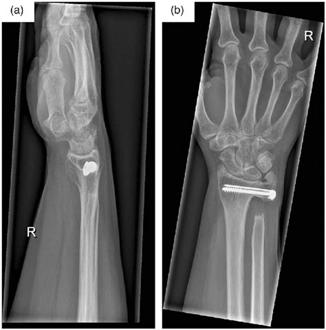 Follow Up Ap A And Lateral B Radiographs Of The Right Wrist 17