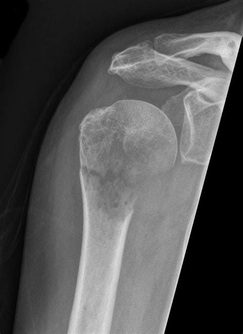 Rt Shoulder Pathologic Fracture Metastases Radiology Medical