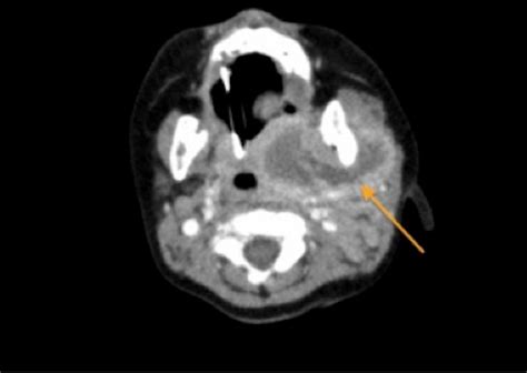 Unusual ‘feathery Cause Of A Parapharyngeal Abscess In An Infant Bmj