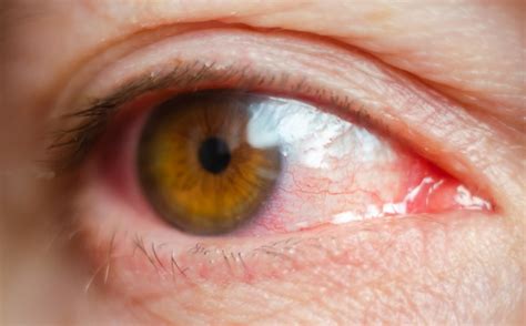 What Causes Eye Infections Bass Urgent Care