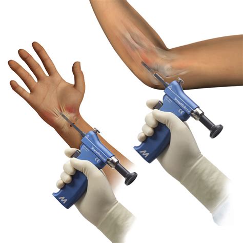 Smartrelease® Endoscopic Carpal And Cubital Tunnel Release By Microaire