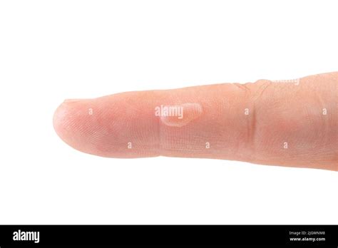 Blister On Finger Skin Human Body Damage Callus Health Care Theme