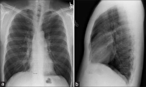 A And B Chest X Ray Postero Anterior PA And Lateral Open I