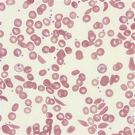 Sickle Cell Anemia Medizzy