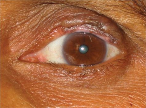 Eyelid Involvement In Disseminated Chronic Cutaneous Lupus