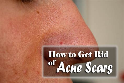 How To Get Rid Of Acne Scars Starsricha
