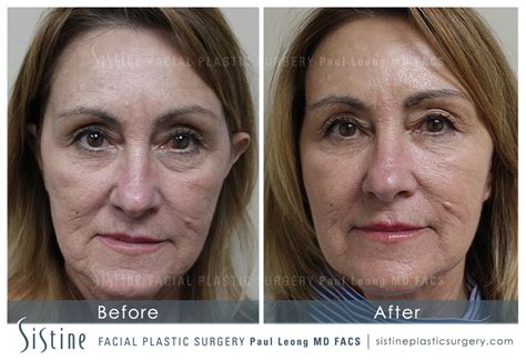 Sculptra Before And After 03 Sistine Facial Plastic Surgery