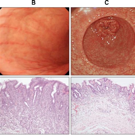 Grading Of Gastritis By Sydney System Acute Inflammation Chronic