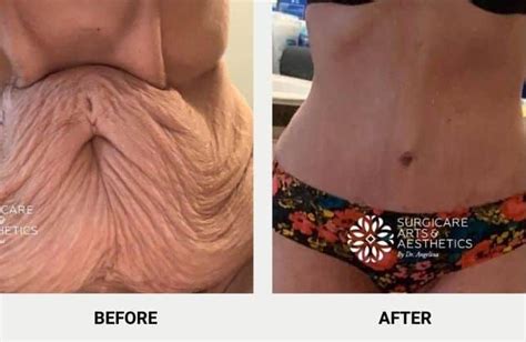 Loose Skin After Weight Loss Post Surgery Causes And Solutions