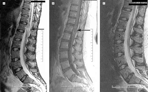 Maybe you would like to learn more about one of these? Transverse Myelitis in Systemic Sclerosis | Dermatology ...