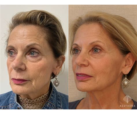 Pdo Thread Lift Before And After Photos Aesthera Medspa