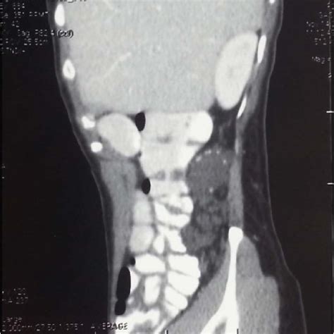 A Abdominal Ultrasonography Of The Left Hypochondrium Showing A