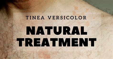 How To Be Sure That Your Tinea Versicolor Natural Treatment Really