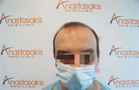 Dsc01502 Anastasakis Hair Clinic