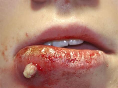 Can you post a picture of the scratch? Bacteria Resistant to all Treatments - Natural Allopathic ...