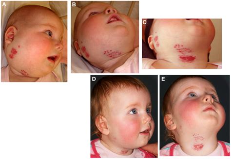 Frontiers Biology Of Infantile Hemangioma Surgery