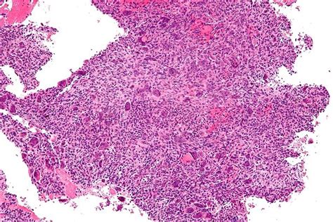 Aneurysmal Bone Cyst Libre Pathology