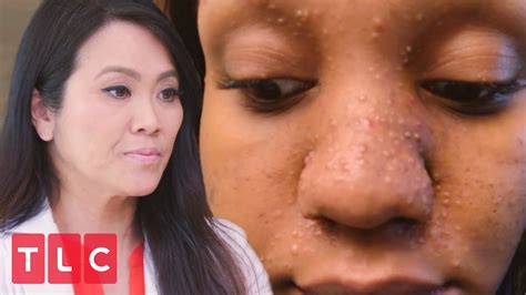 Tiny Bumps All Over Her Face Dr Pimple Popper Before The Pop Youtube