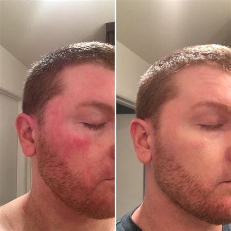 How To Hide Red Face Guide For Men Info In Comments Eczema