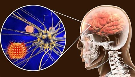 Meningitis Síntomas Tratamiento Y Prevención