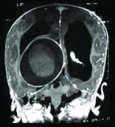 T1w Post Contrast Mri Coronal Image Showing Encapsulated Peripherally