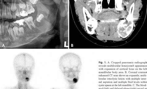 Figure 1 From Aneurysmal Bone Cyst Of The Mandible Managed By