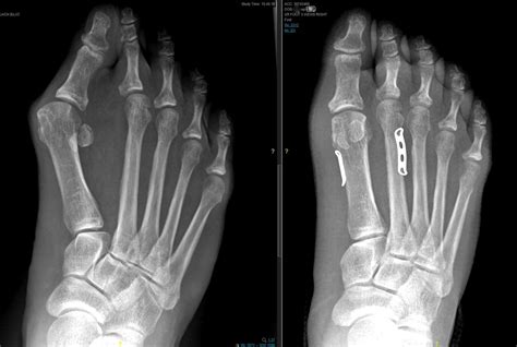 The Syndesmosis Bunionectomy — Bellevue Podiatric Physicians
